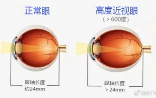 视力多少为近视，视力多少为近视眼？